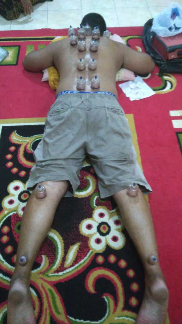 Bekam Pria / Cewek